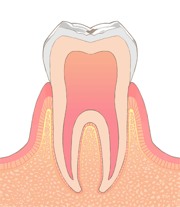 初期の歯周病（歯肉炎）