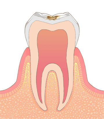 C1(歯のエナメル質にできた虫歯)