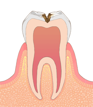 C2(歯の象牙質にできた虫歯)