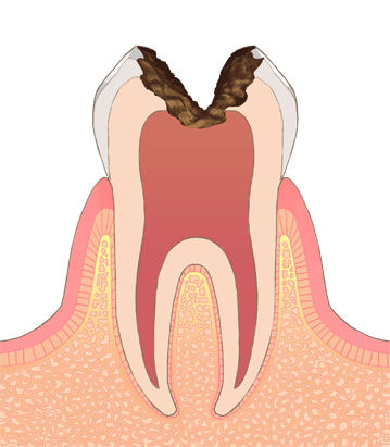C3(歯の神経にまで達した虫歯)
