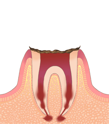 C4(歯の上部がボロボロに溶けてなくなり、根元だけが残った状態)
