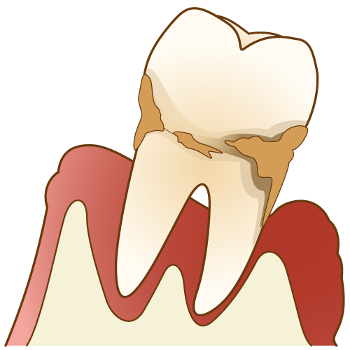 歯周病の症状