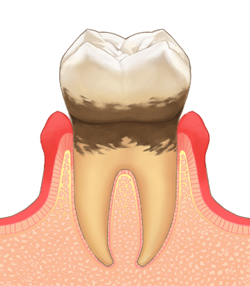 中期の歯周病（歯周炎）