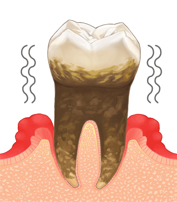 重度の歯周病（重度歯周炎）